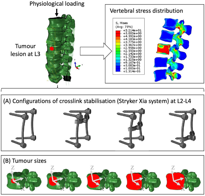 Graphical abstract: lumbar spine tumour FE model showing vertebral stress distribution under physiological loading and cross-link stabilisation configurations